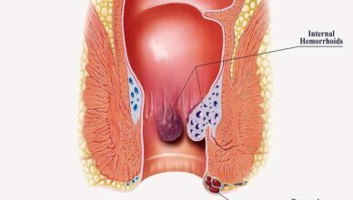 Hemorrhoids