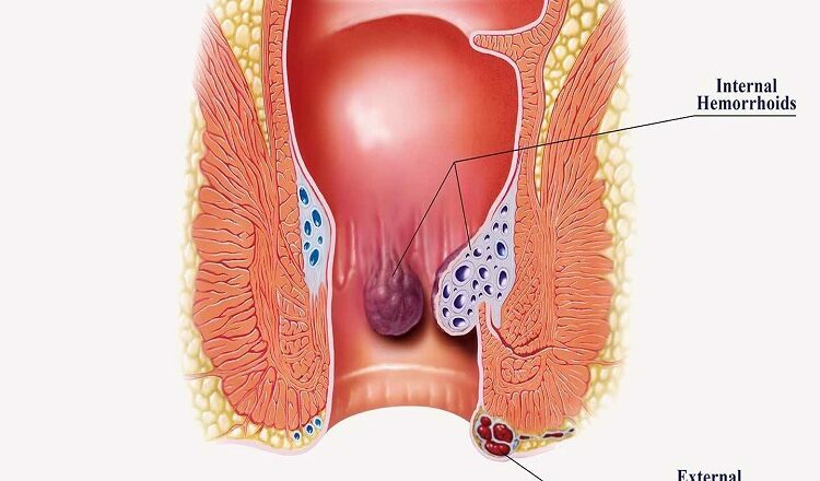 What You Need to Know About Hemorrhoids Hemorrhoids