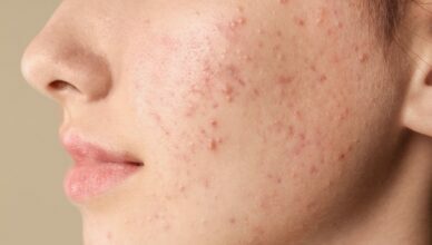 Acne