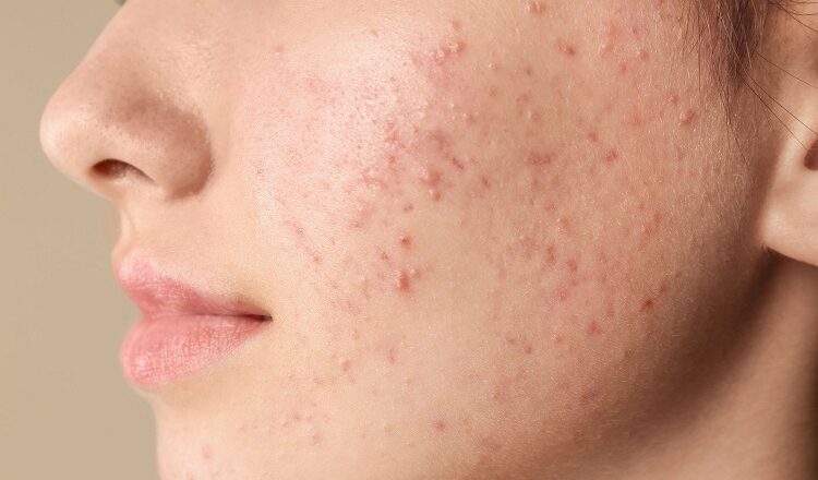 Acne