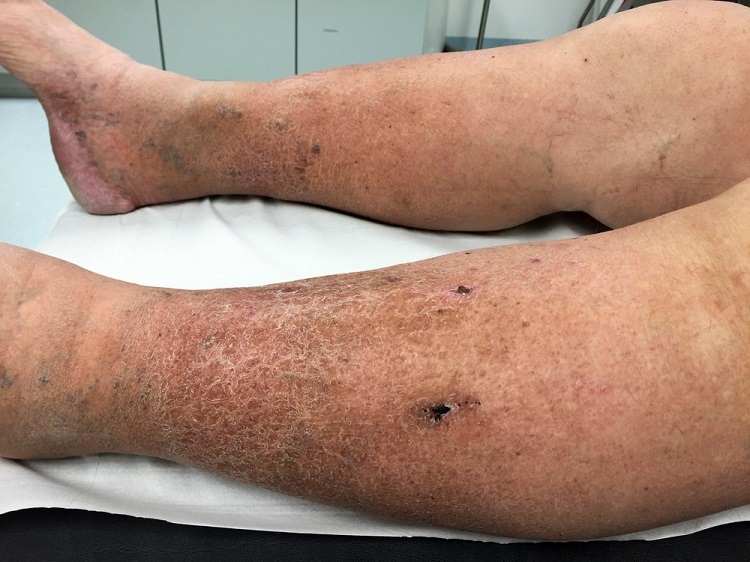Venous Insufficiency