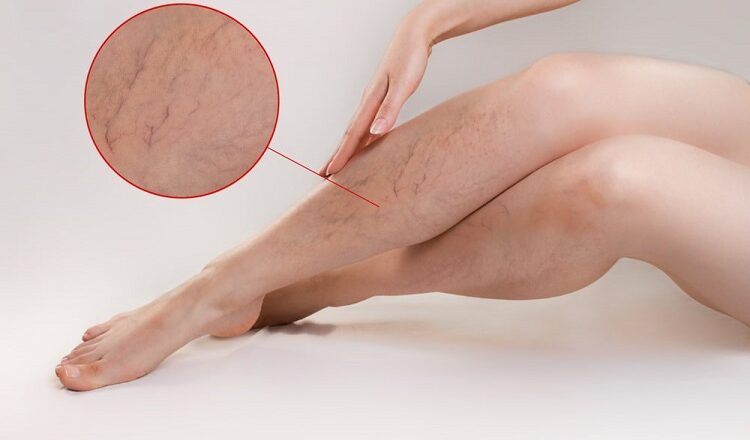 Do Compression Stockings Really Work for Varicose Veins? Varicose Veins