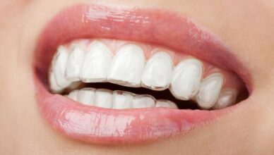 invisalign aligners