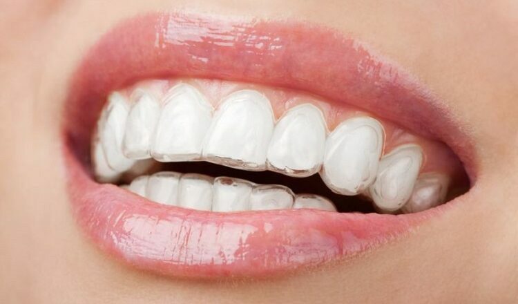 invisalign aligners