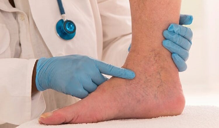 Reasons Why You May Have Spider Veins Spider Veins