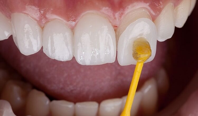 What Do You Know About Dental Veneers? Dental Veneers