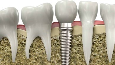 Extracted Tooth