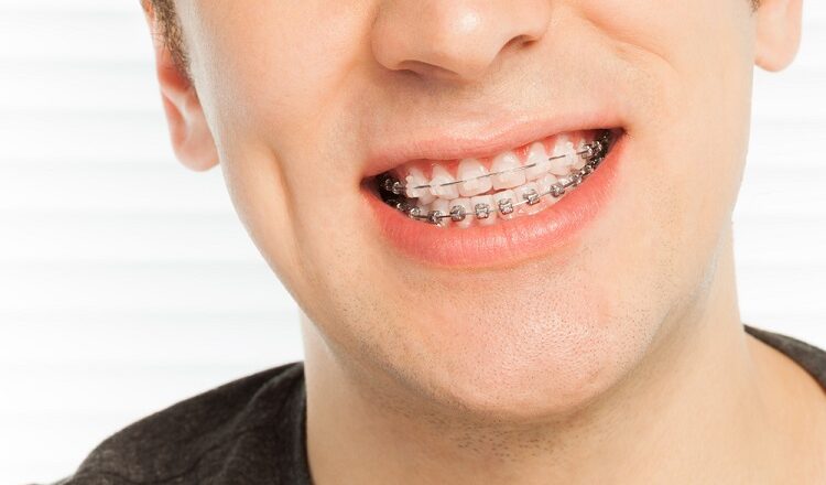 Traditional Braces Or Invisalign London For Teeth Straightening? Traditional Braces