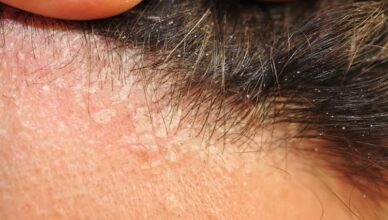 Dandruff